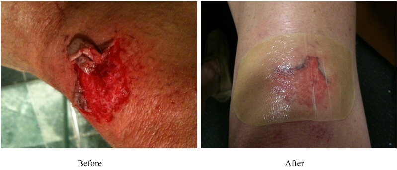 road rash injuries